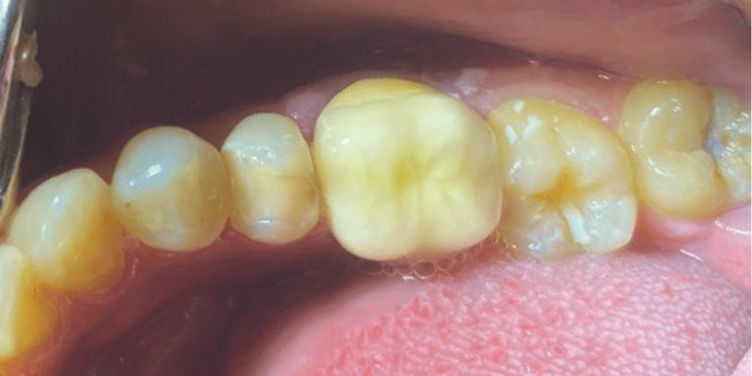 Crown 4 1