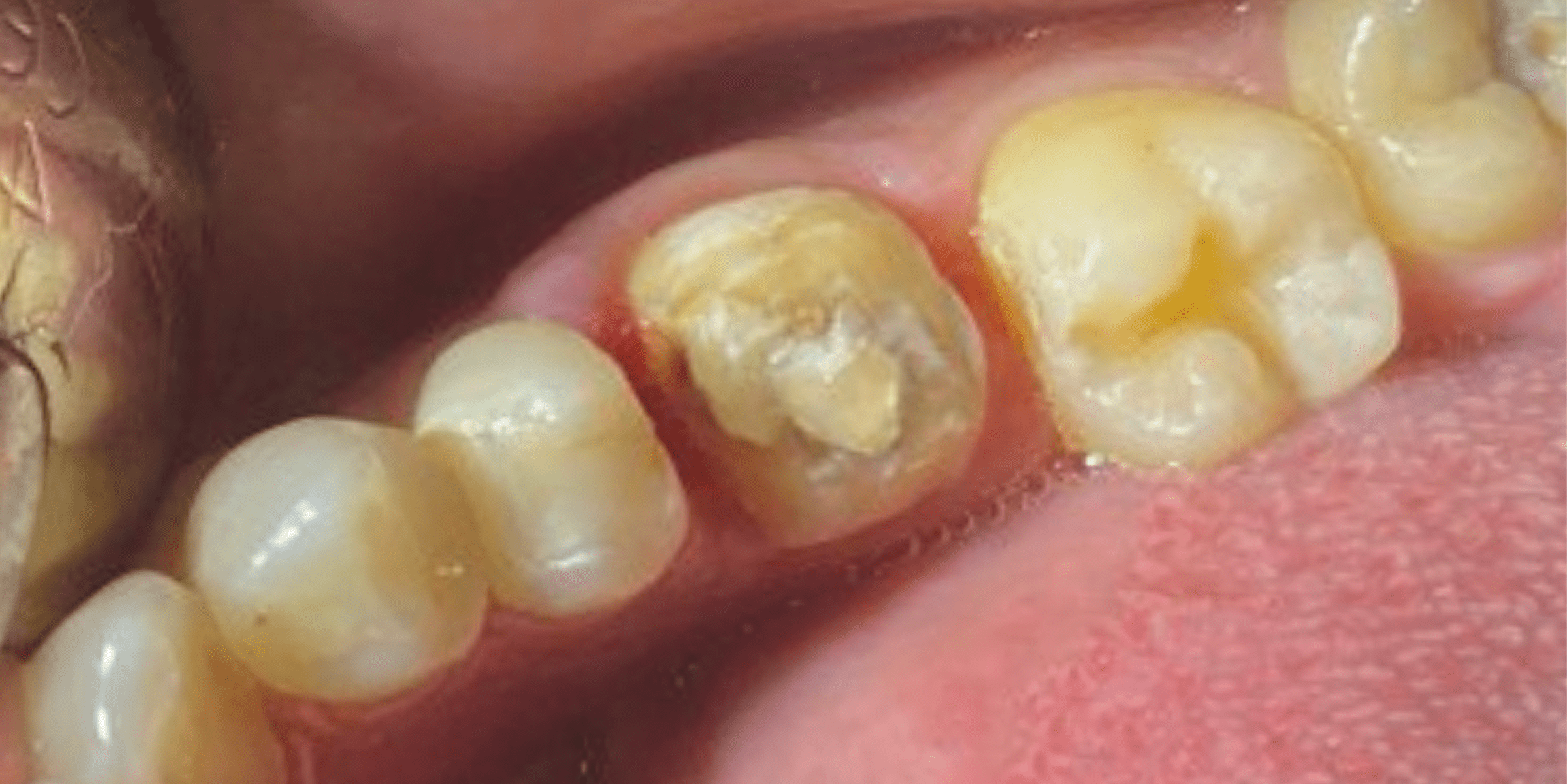 Crown 4