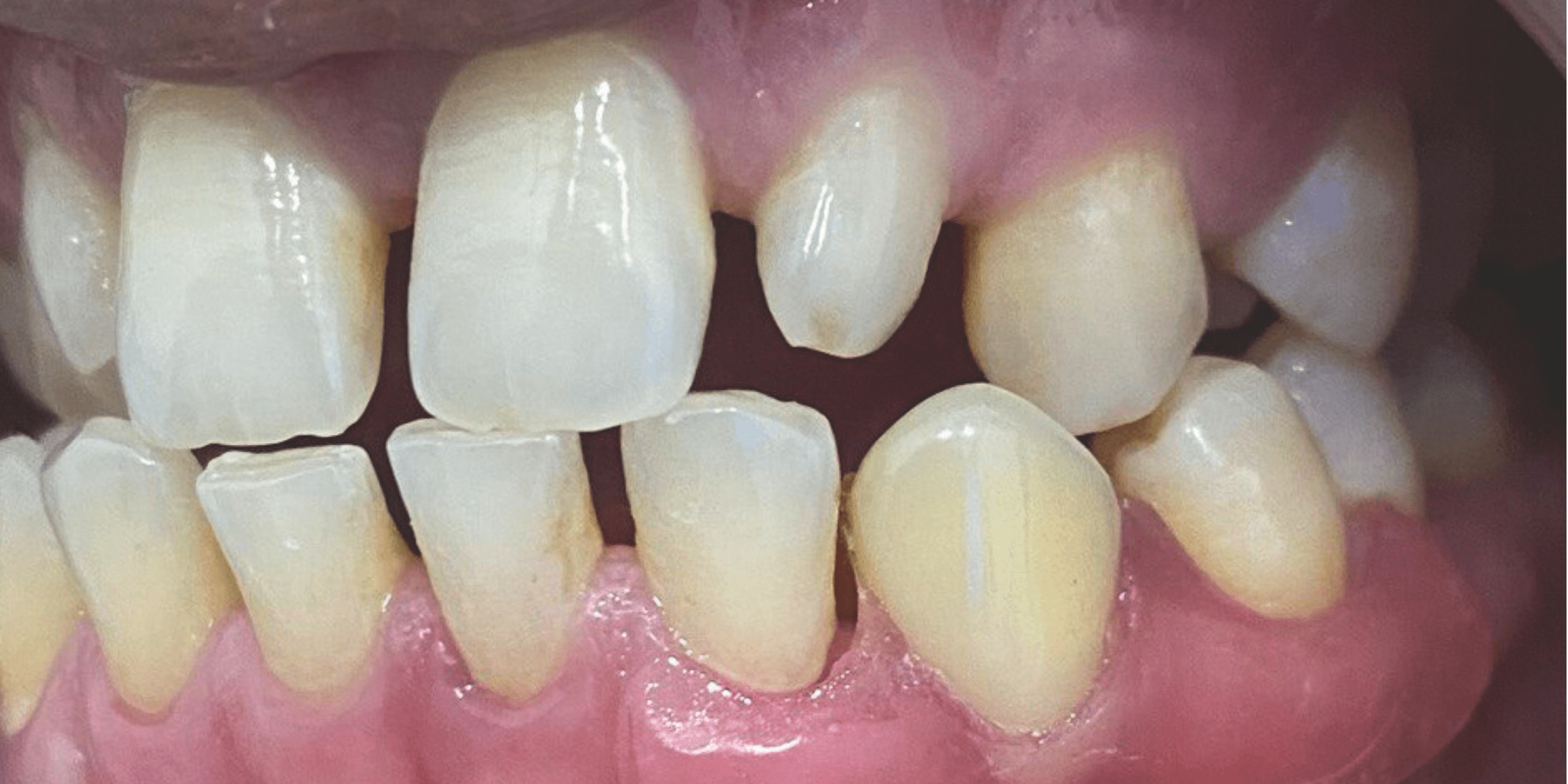 Removable denture 1 1