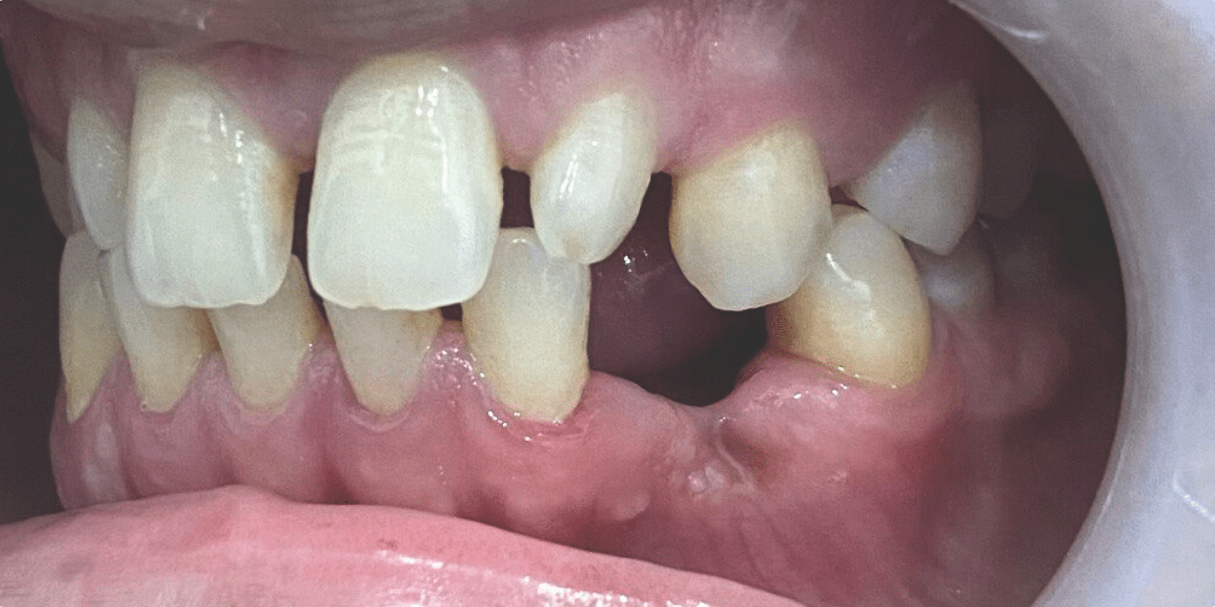 Removable denture 1