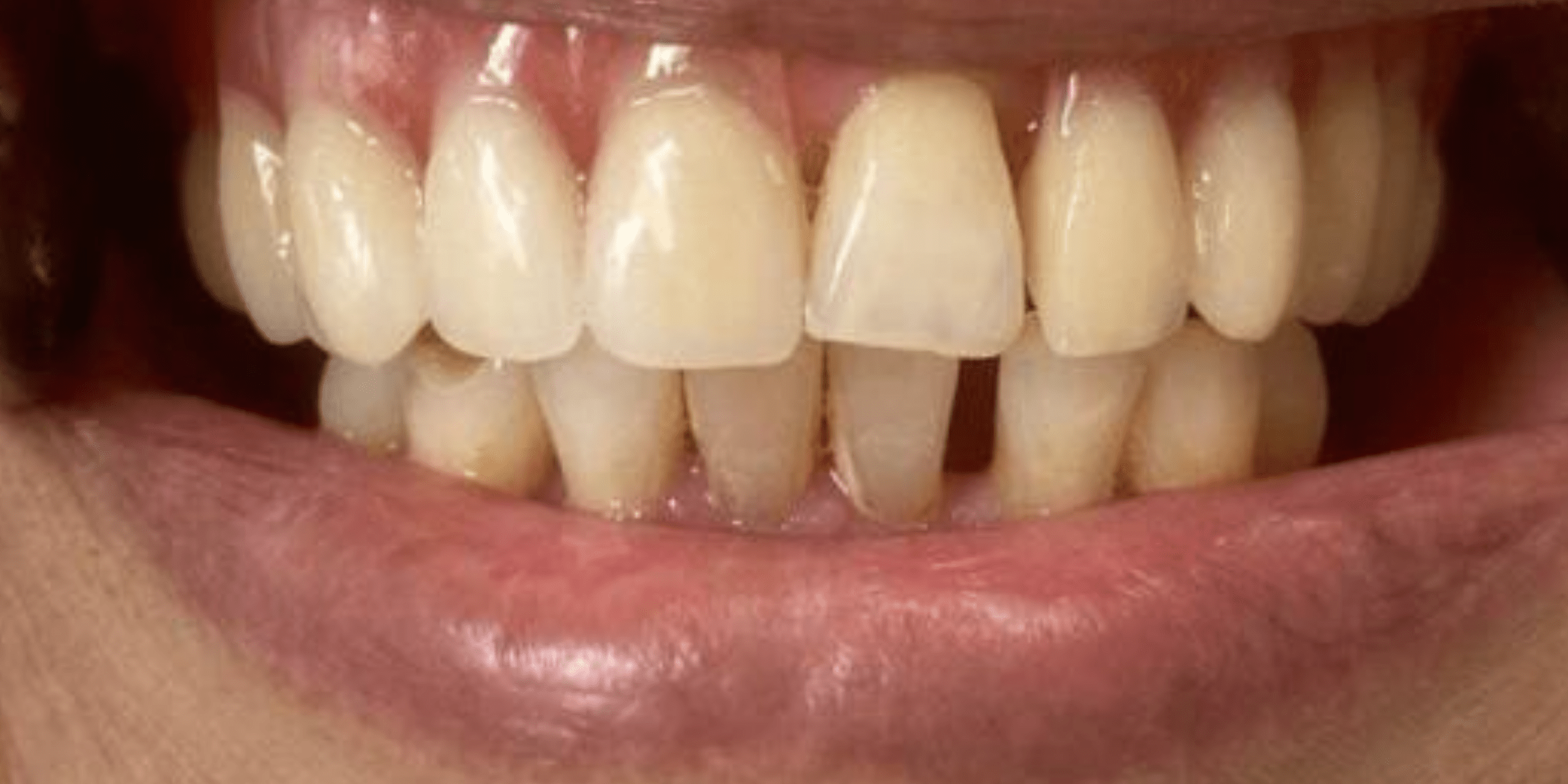 Removable denture 2 1