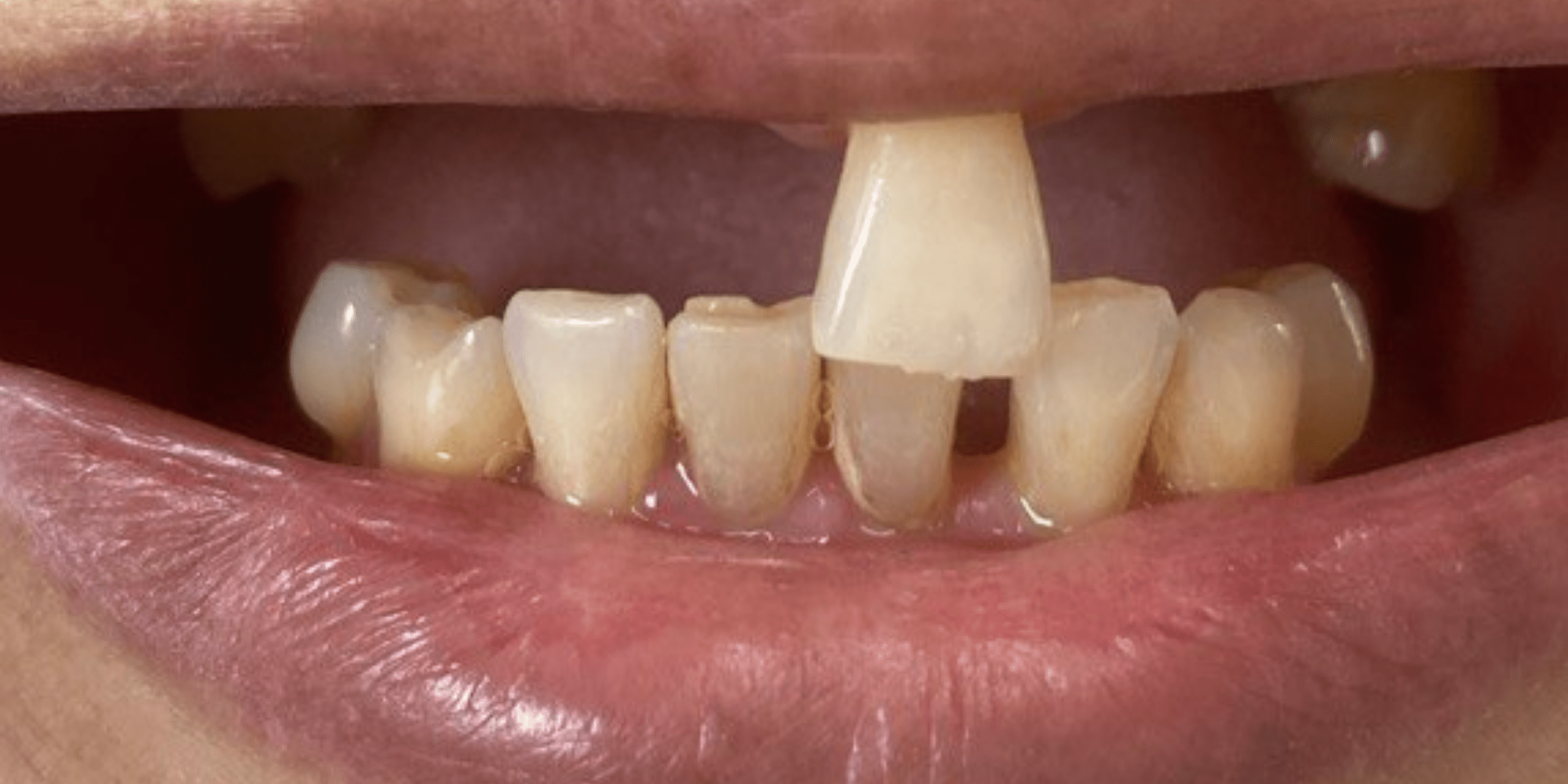 Removable denture 2