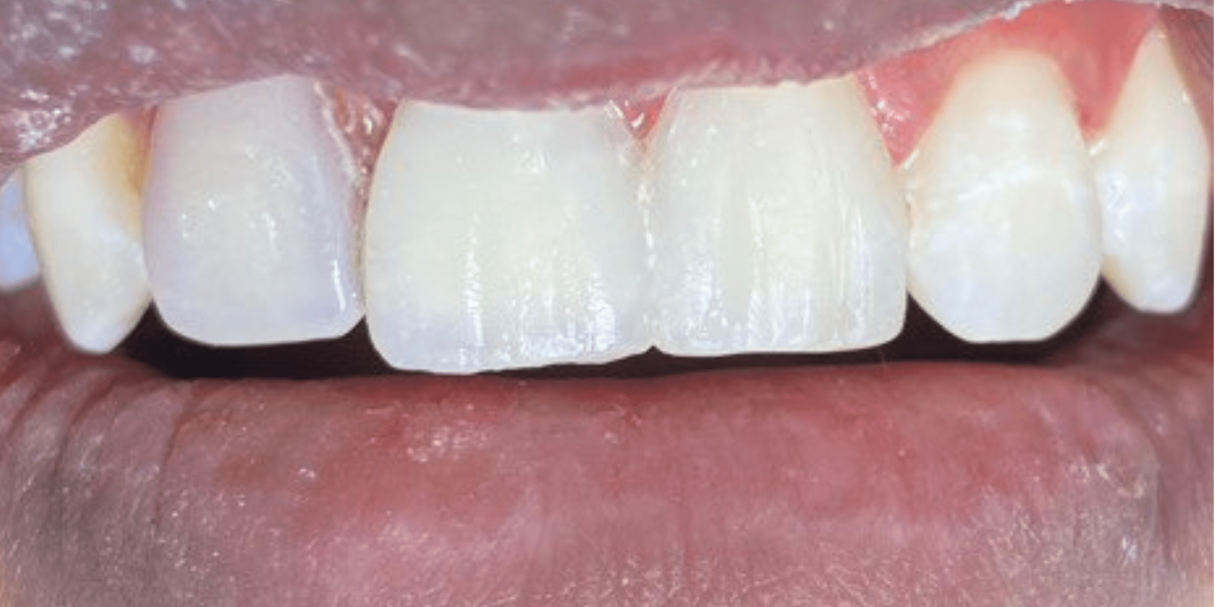 Tooth filling 1 1