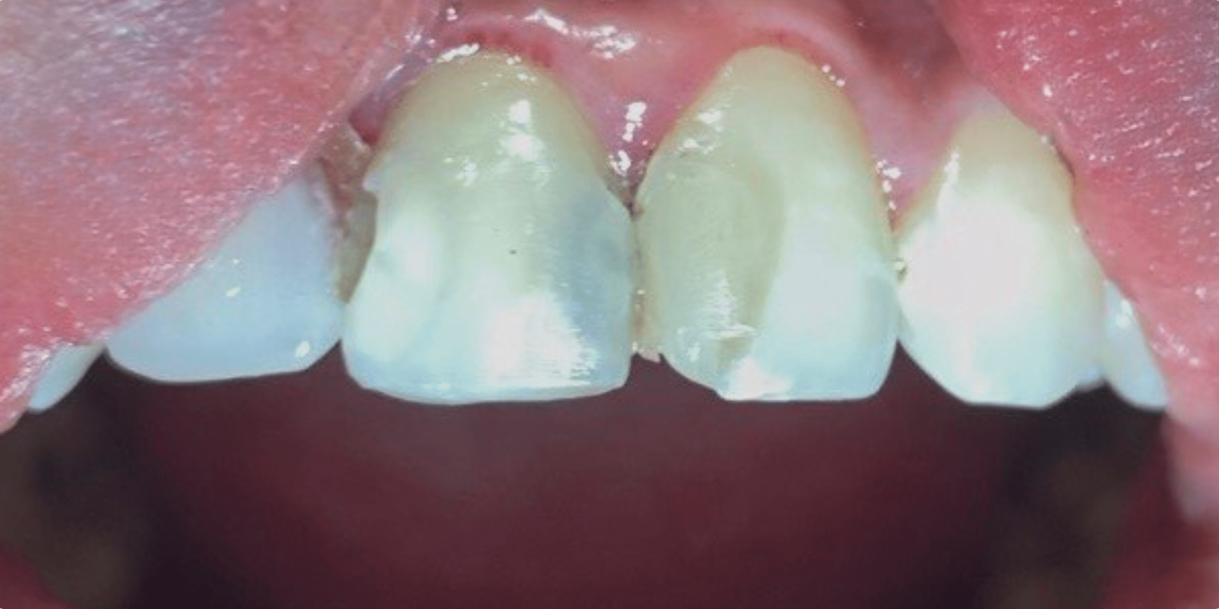 Tooth filling 1