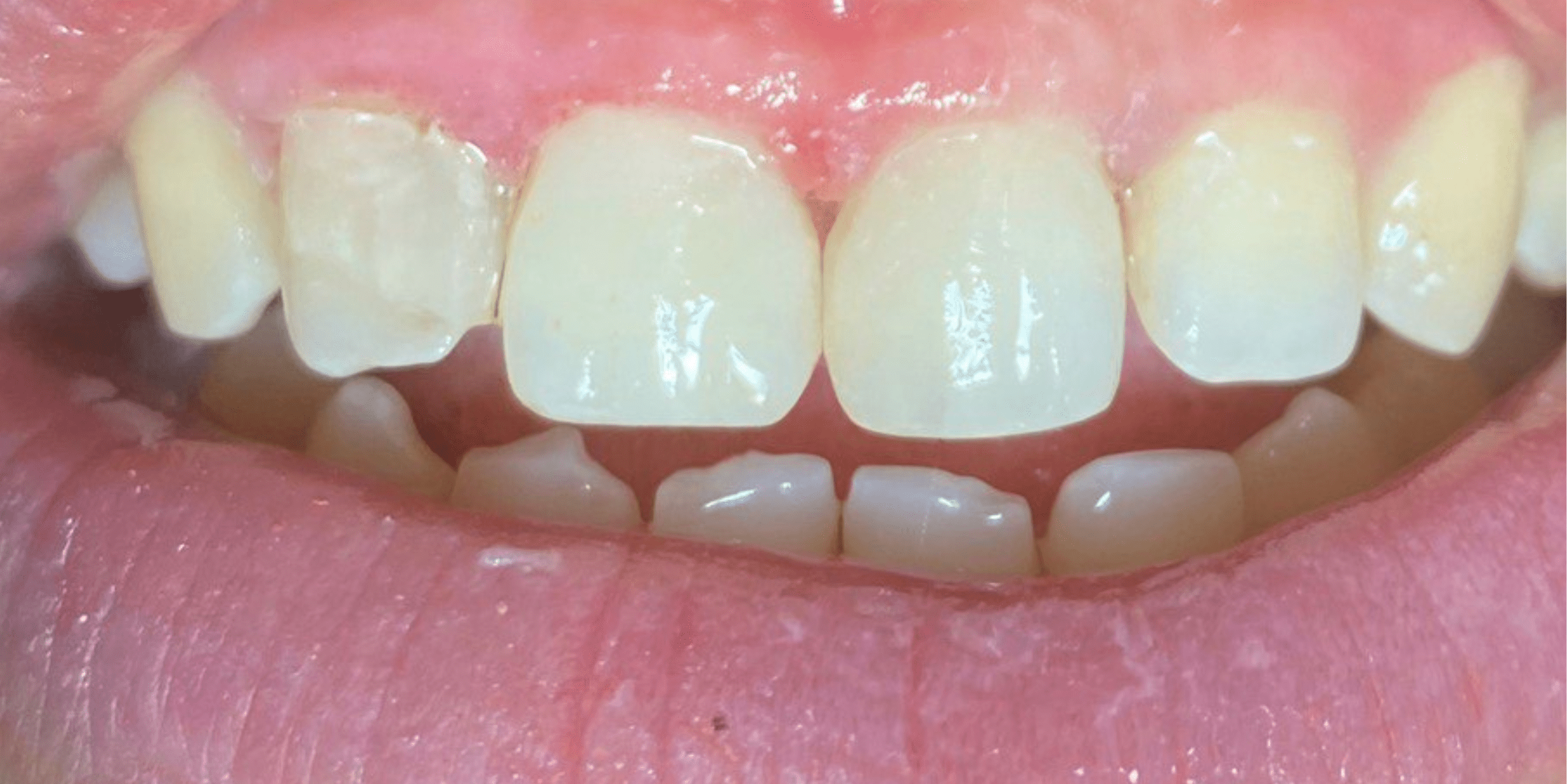 Tooth filling 2 1