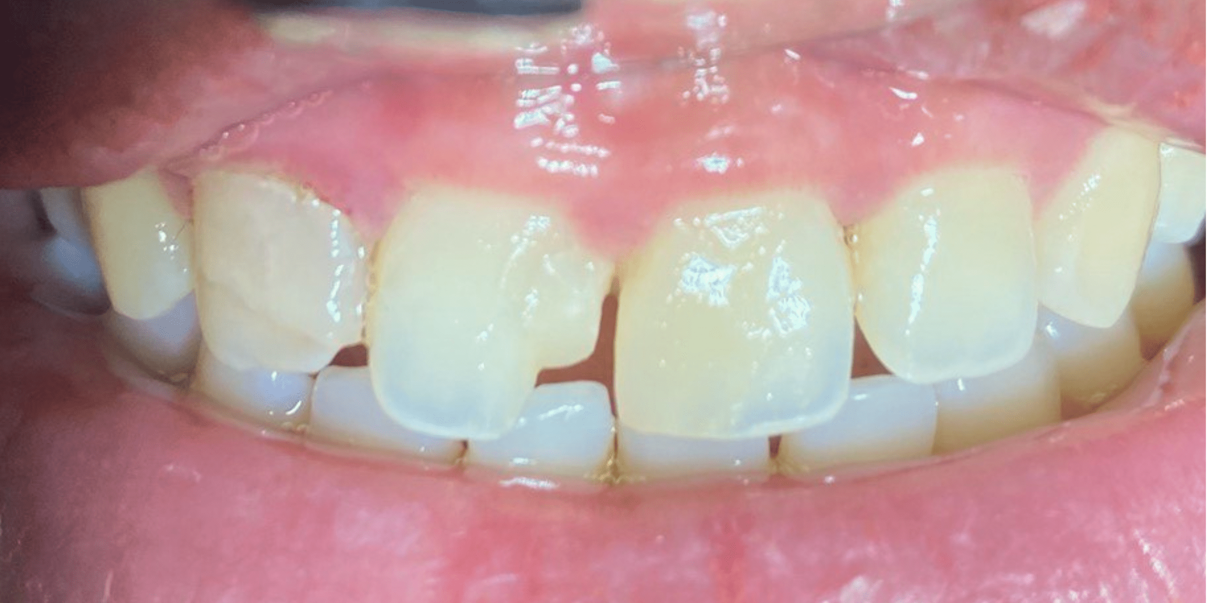 Tooth filling 2