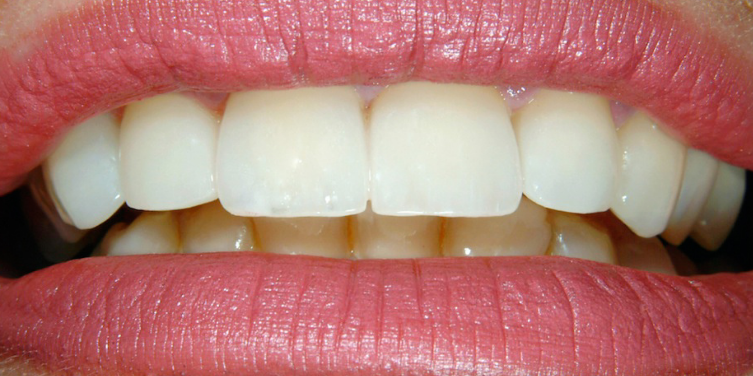 Veneer 1 1