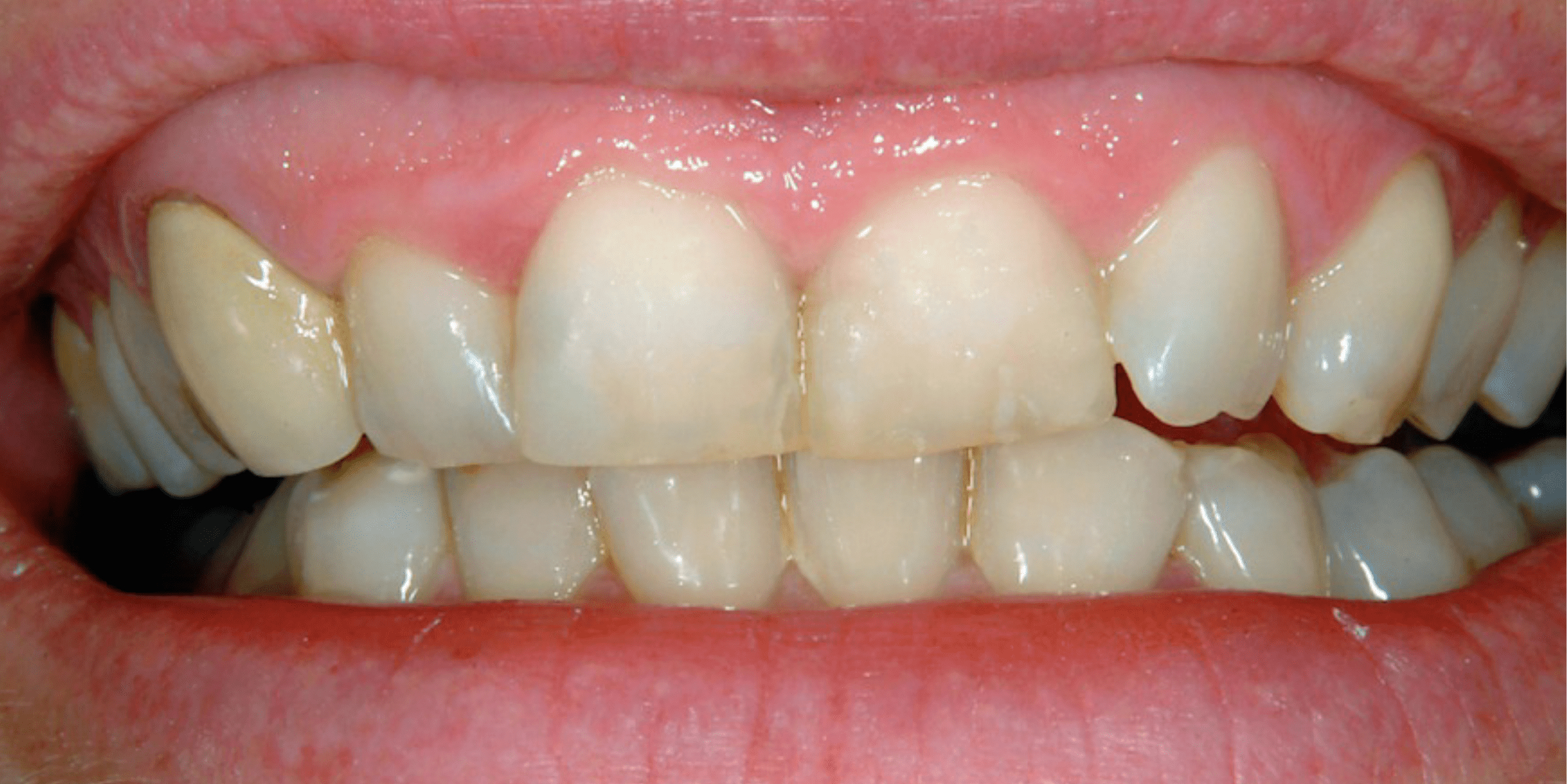 Veneer 1