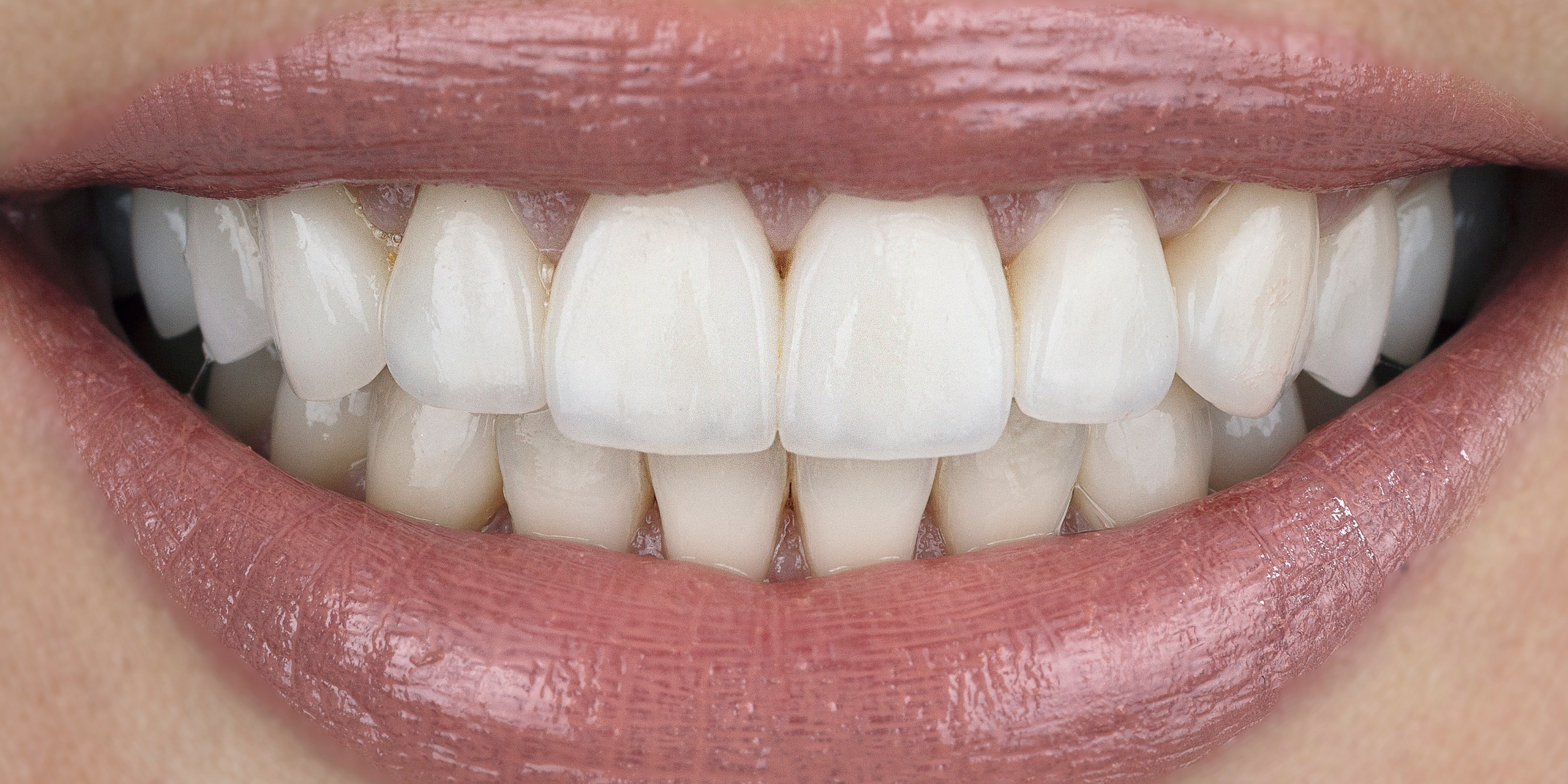 Veneer 2 1