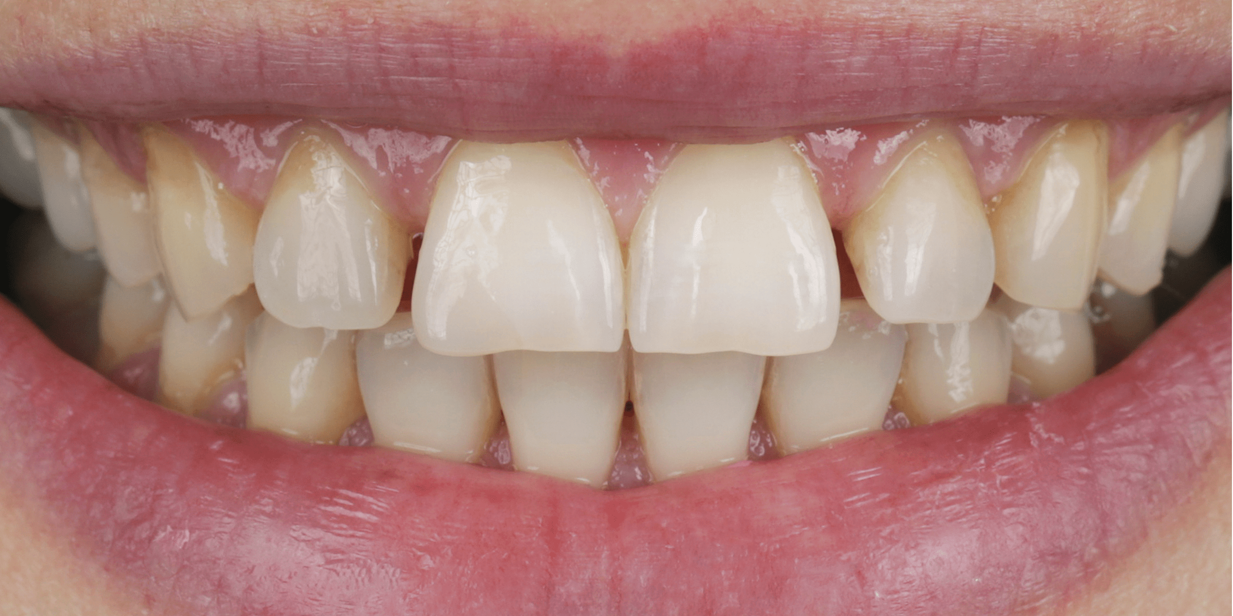 Veneer 2