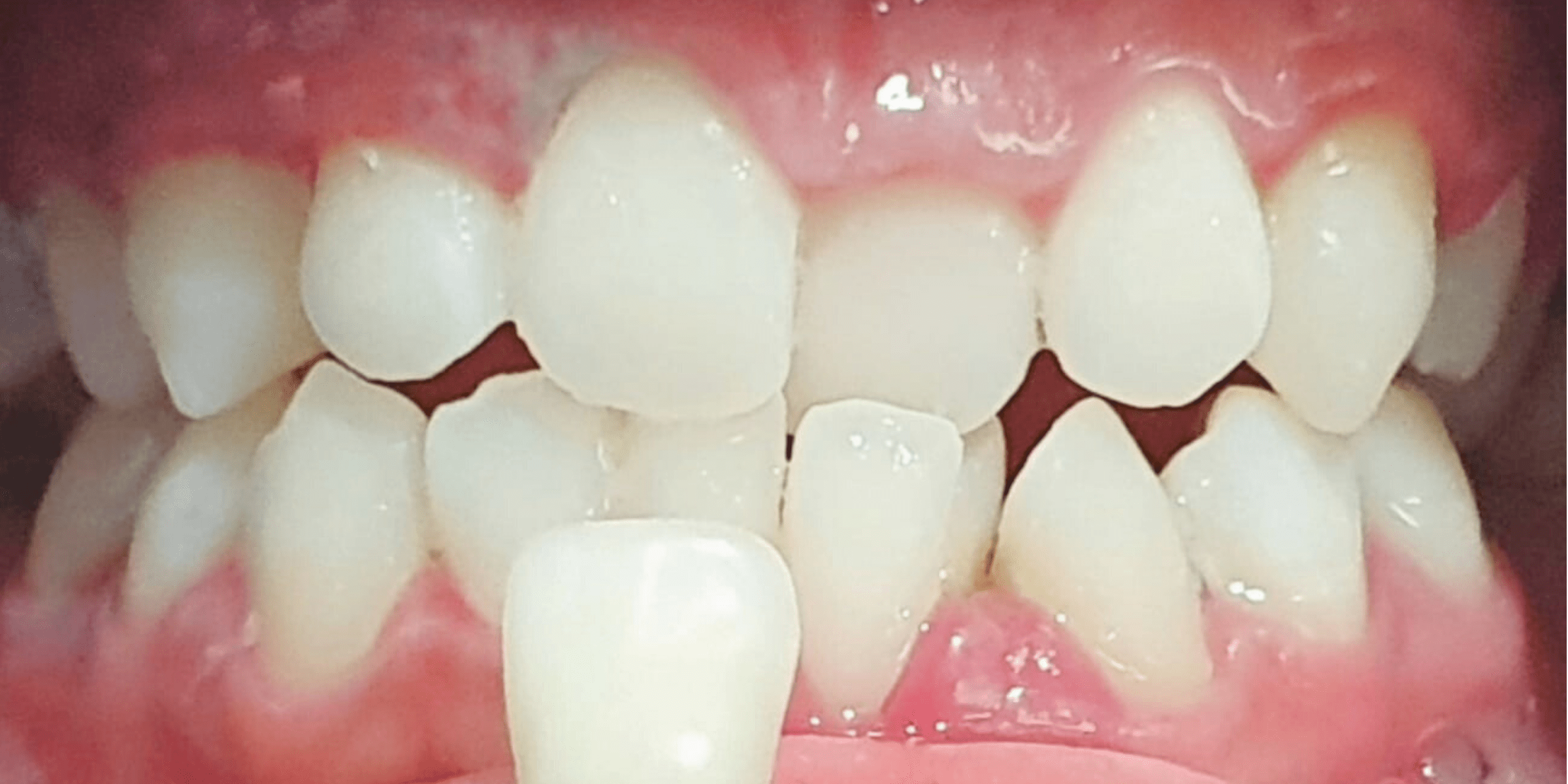 bleaching 1 2