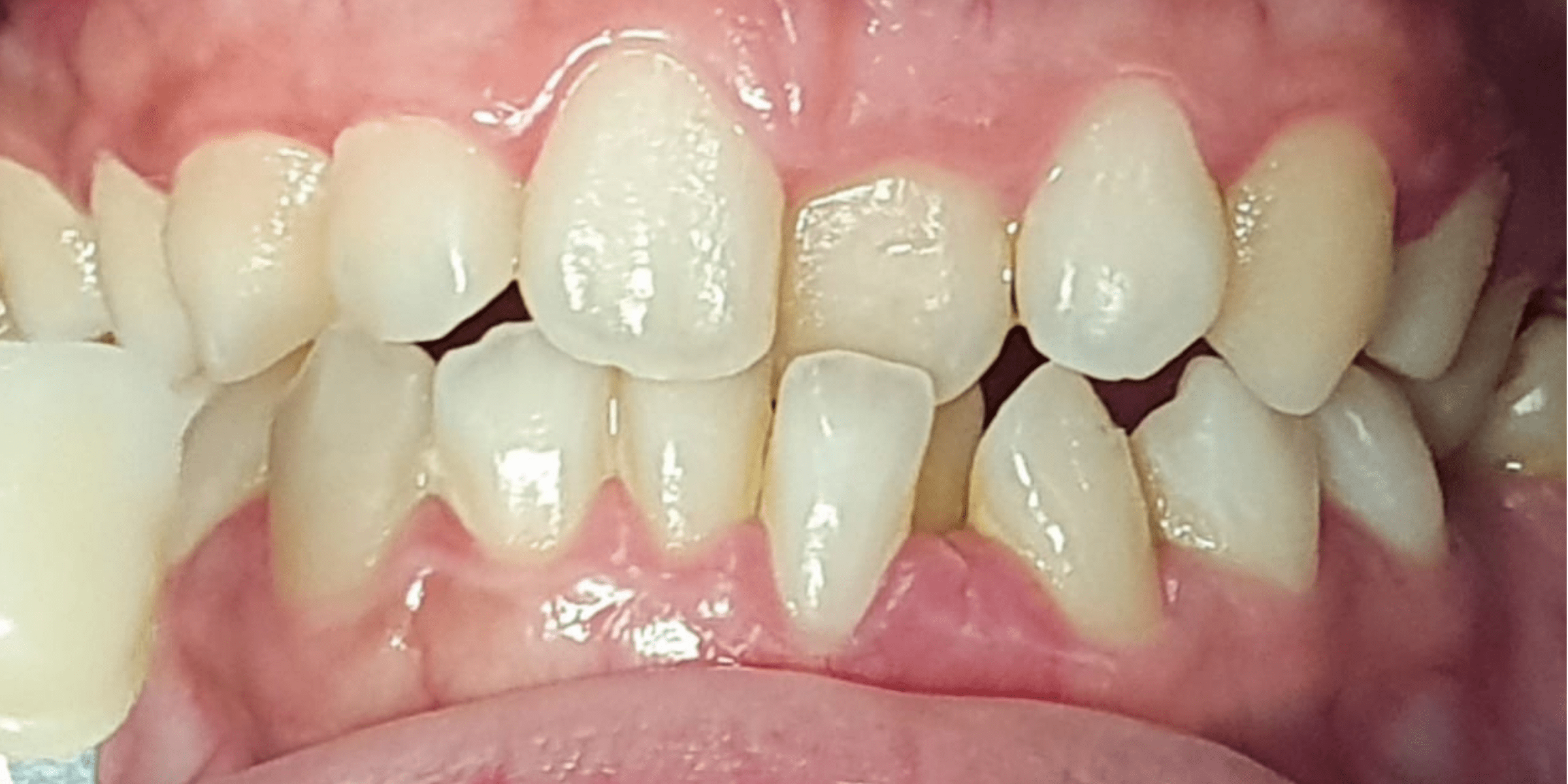 bleaching 1