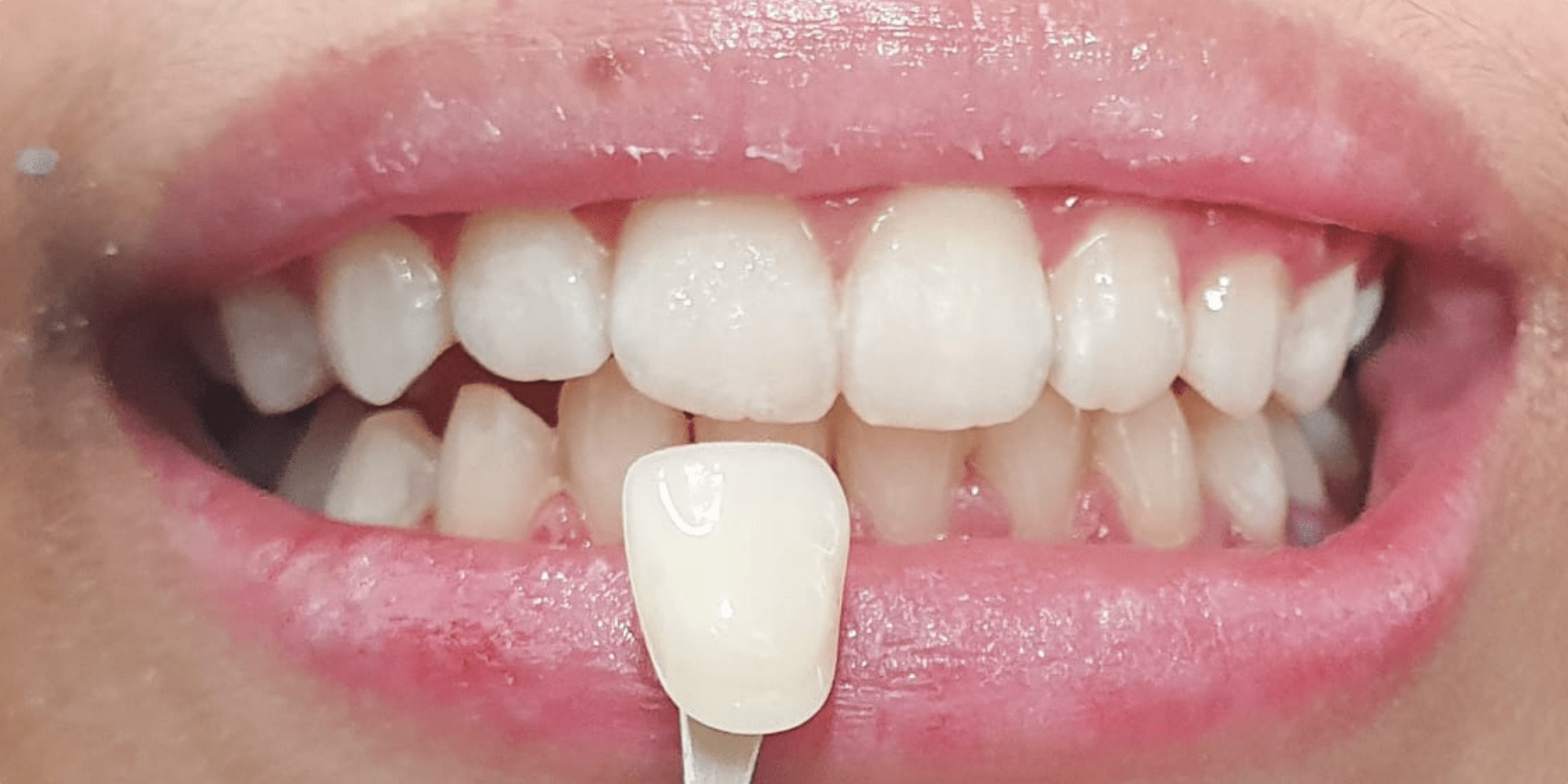 bleaching 2 1