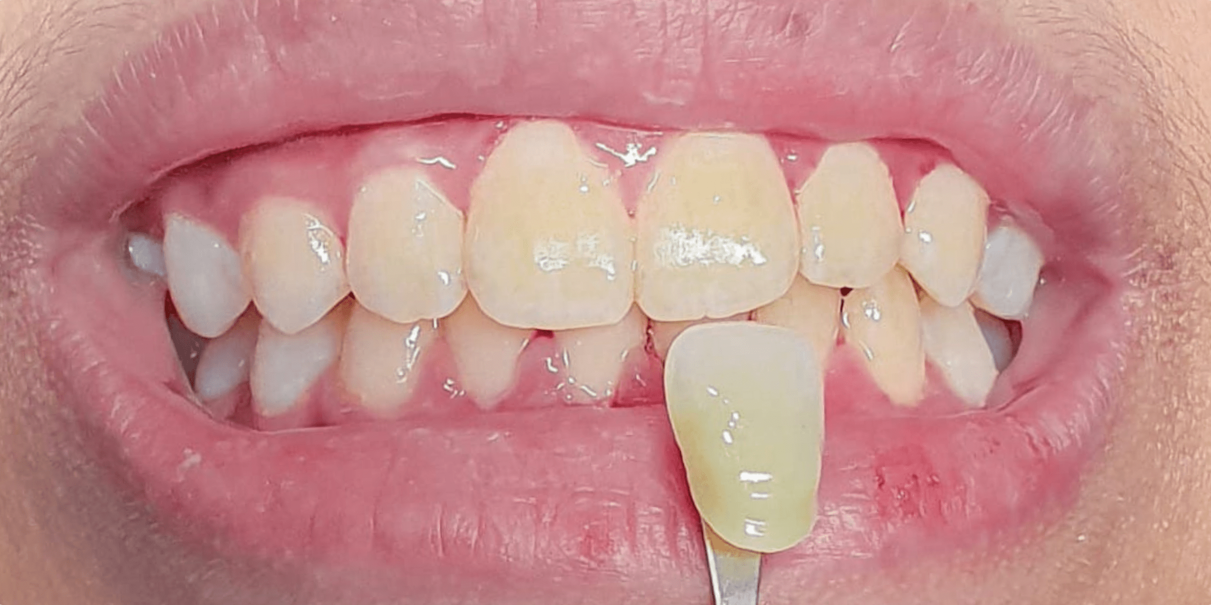 bleaching 2