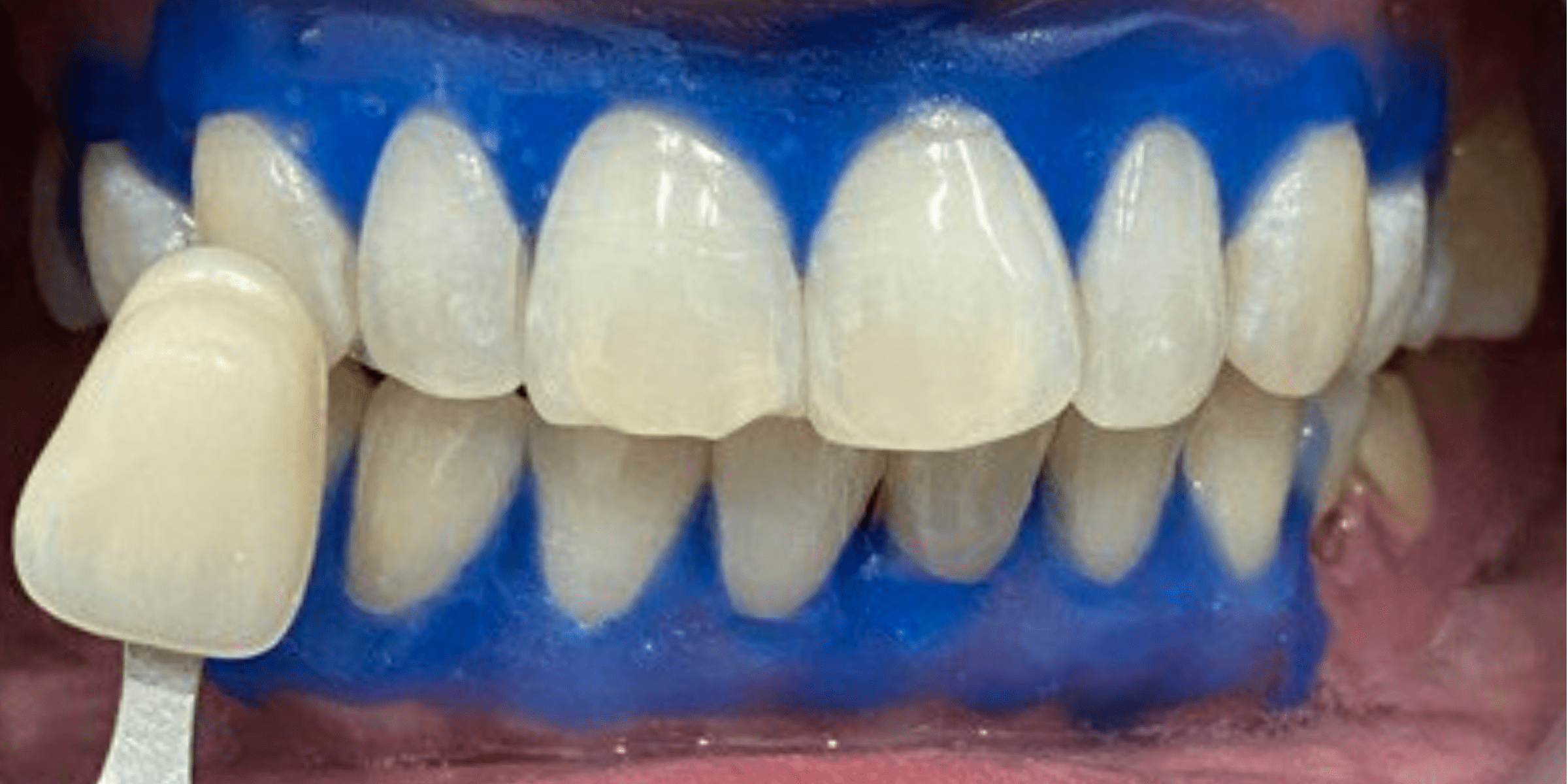 bleaching 3 1