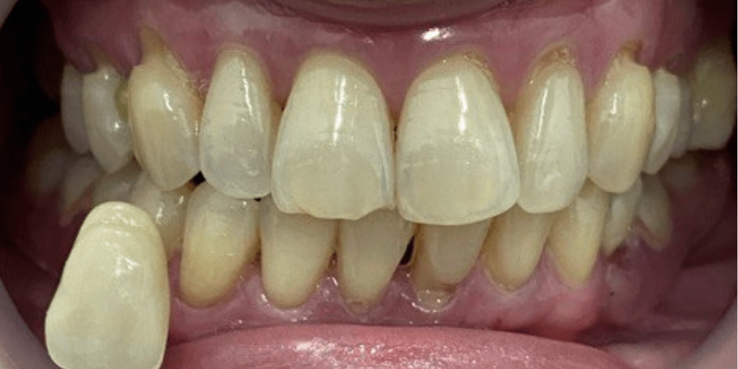 bleaching 3