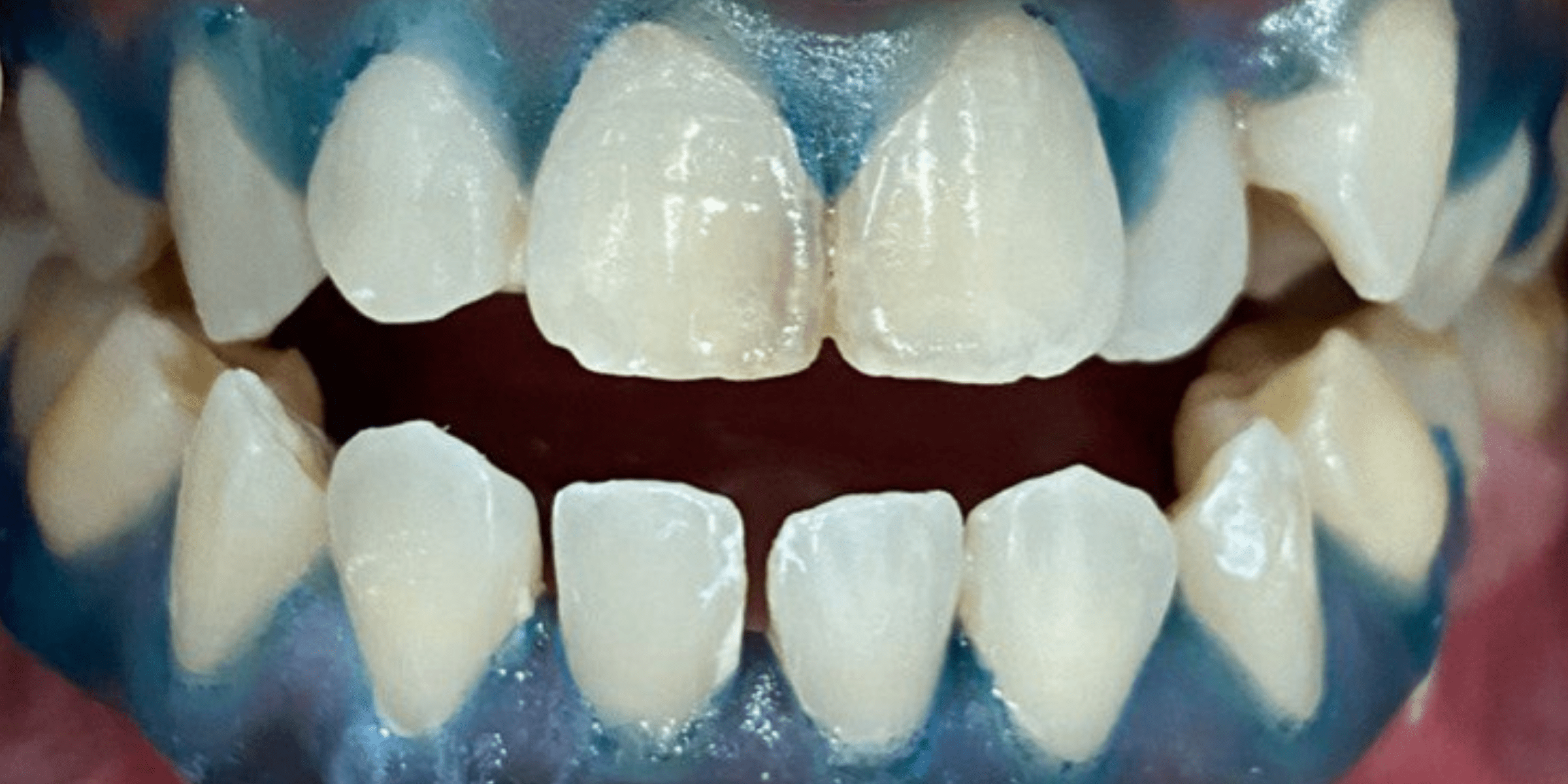 bleaching 4 1