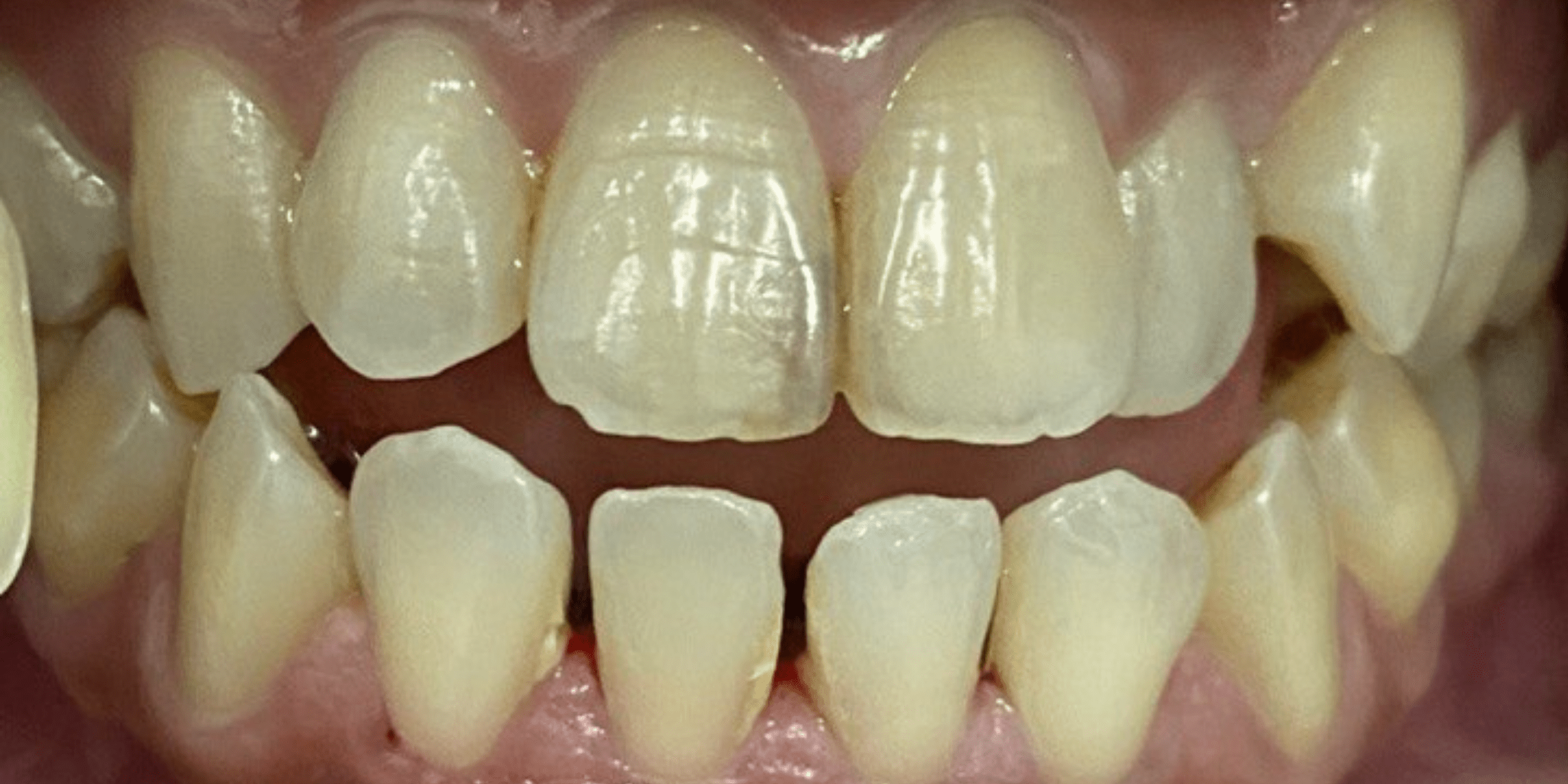 bleaching 4