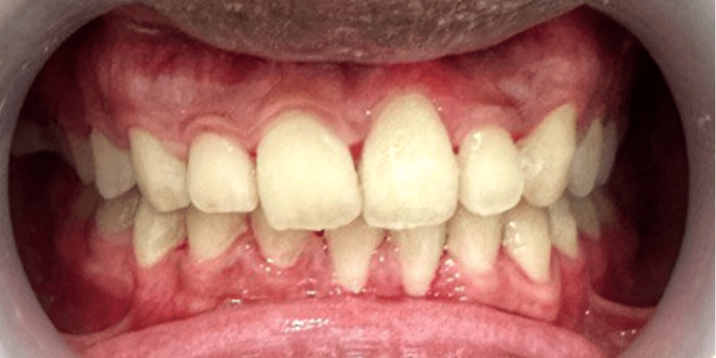 braces 2 1