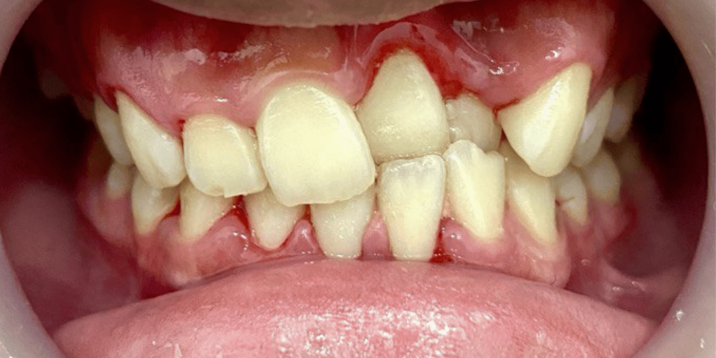 braces 2