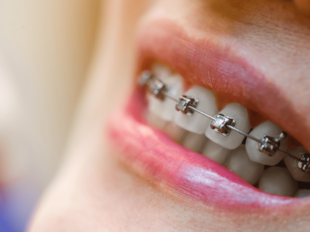 Behel Self Ligating: Kelebihan dan Tahap Pemasangan