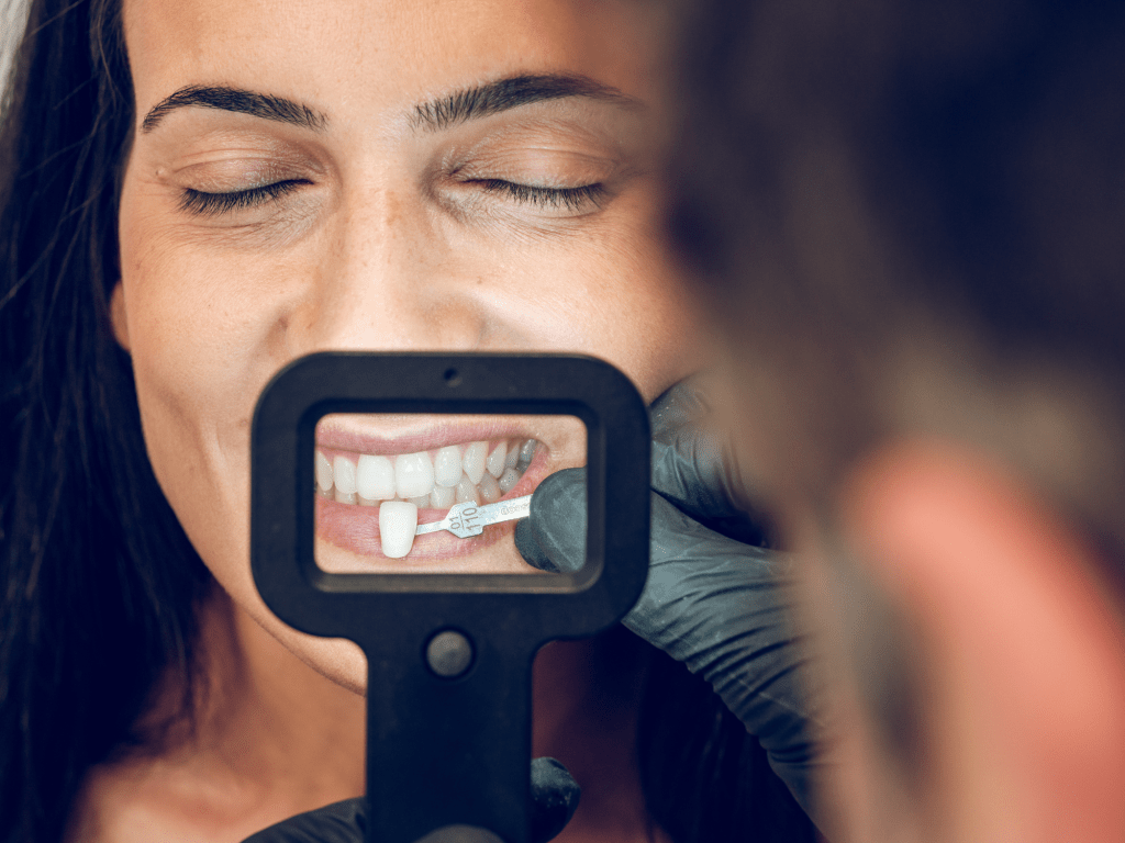 Ketahui Veneer Gigi: Solusi Estetika di Neo Art Dental Center