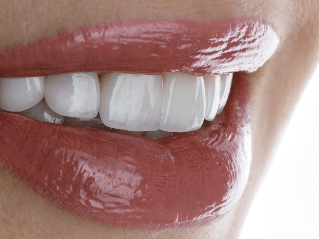 Apa Veneer Gigi? Panduan Lengkap dari Neo Art Dental Center