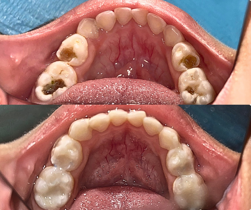 Cerita Si Kecil dan Gigi Ngilu: Pengalaman Penambalan Gigi Anak di Neo Art Dental