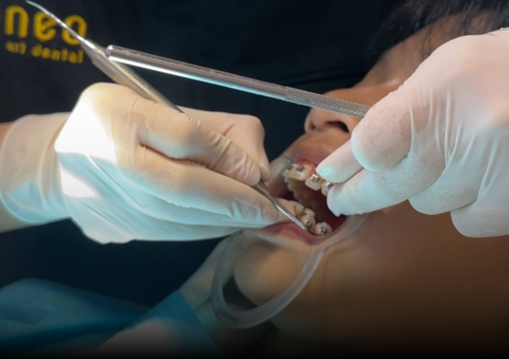 Cerita Pasien: Dari Gigi Berantakan Jadi Lebih Rapi  dengan Behel di Neo Art Dental