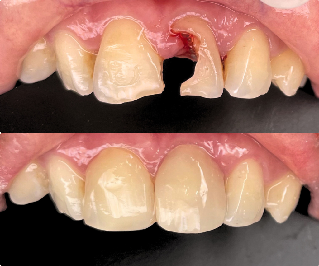 Veneer Gigi: Dari Gigi Patah Jadi Lebih Percaya Diri dengan Veneer di Neo Art Dental