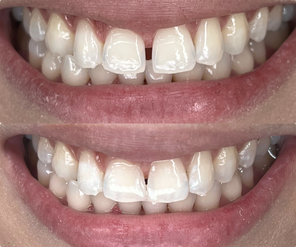 Dari Galau Jadi Glow Up! Veneer Gigi Depan Renggang di Neo Art Dental