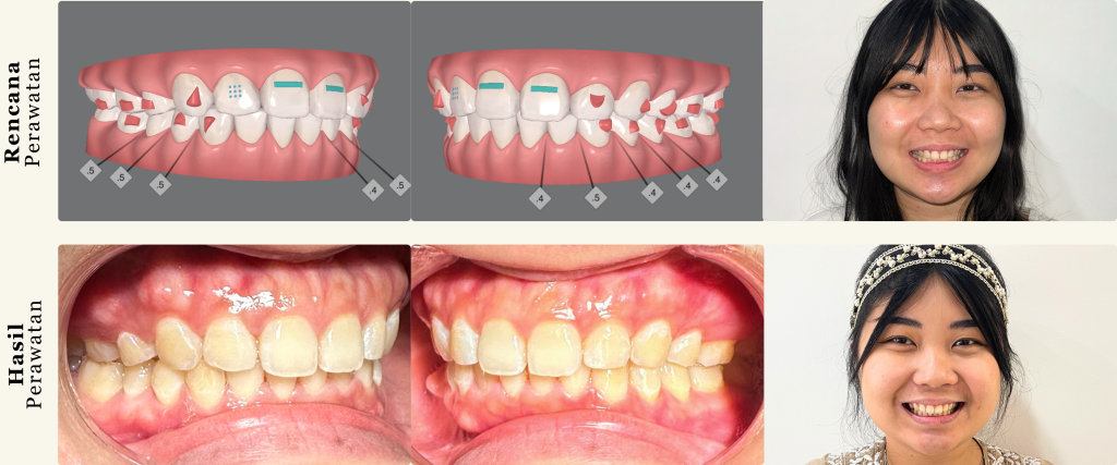 Senyum Lebih Stylish dengan Clear Aligner Invisalign